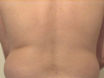 Liposuction-Before