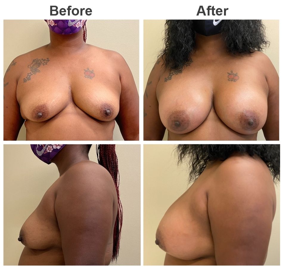 Front and side view 550 cc implants before and after photos Breast Augmentation Before and After | Vincent N. Zubowicz, MD
