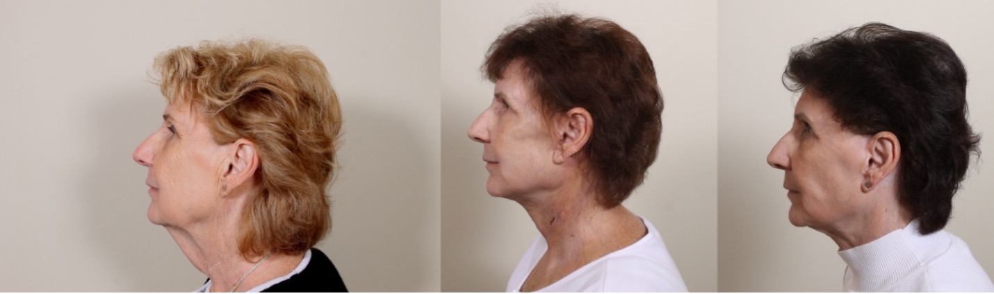 older woman before and after sequential tension sutures composite facelift