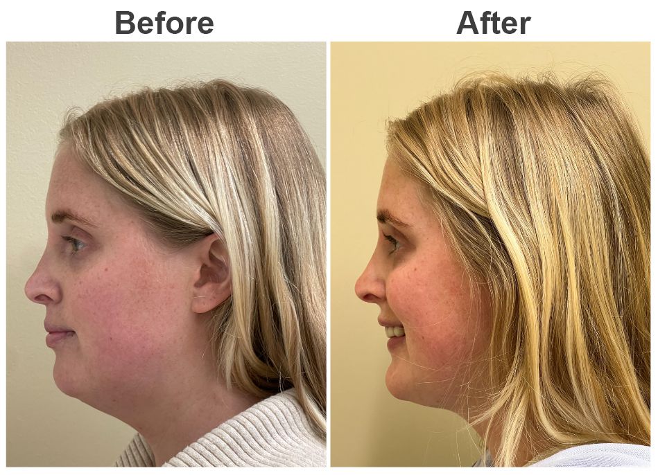 24 year old before and after photos 5 weeks post chin and neck liposuction Liposuction Before and After | Atlanta Liposuction | Dr. Zubowicz