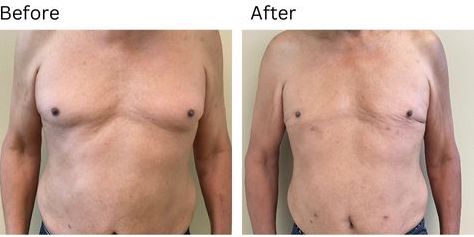 70 year old male before after gynecomastia surgery front and side view2022jpg